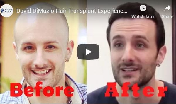 FUE Hair Transplant - Austin & Houston, Texas (TX)