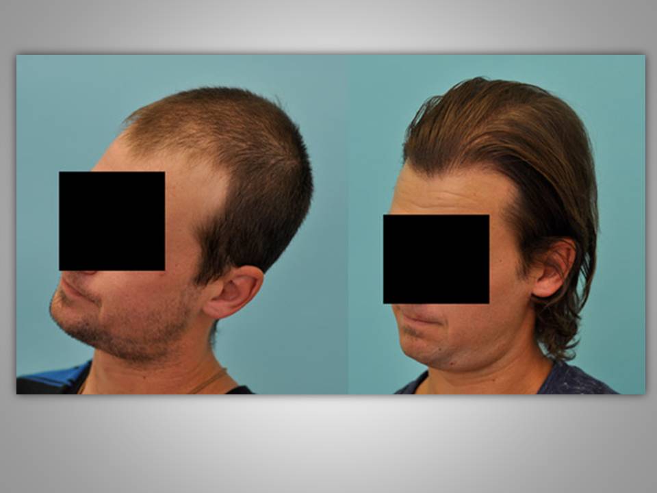 Before & After Photos - McGrath Medical Hair Restoration Texas